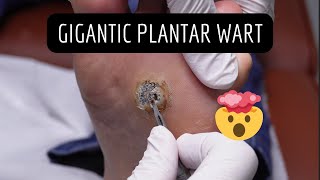 GIGANTIC Wart Removal Verruca Needling [upl. by Annoirb]