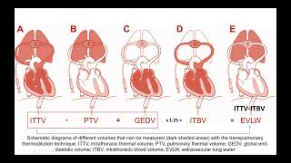 Transpulmonary Thermodilution method Case studies [upl. by Dwan]