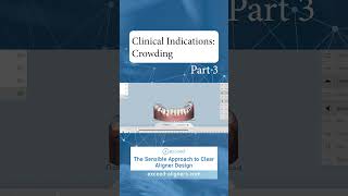 Clinical Indications Crowding Part 3 [upl. by Attiuqaj]