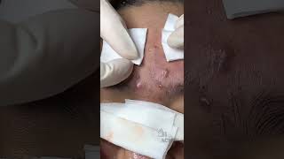 Inflamed Acne and Blackhead Removal CloseUp [upl. by Eicul]