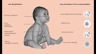 Dossier clinique corrigé en Pédiatrie  Bronchite aiguë ENCi [upl. by Rurik]