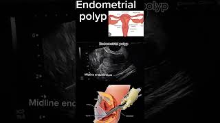 Endometrial Polyp Case Study A StepbyStep Diagnosis health ultrasound polyp DrSaimakhan [upl. by Santos]