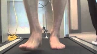 Arthritis big toe Video Gait Analysis Orthotics heel pain Mississauga Brantford Podiatry Chiropody [upl. by Burra691]