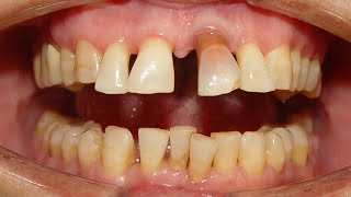 Severe Median Diastema due to Pathological drifting of Upper front teeth [upl. by Enomaj]