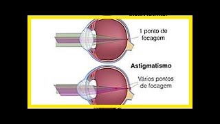 Symptome von Astigmatismus und wie man behandelt [upl. by Esekram]