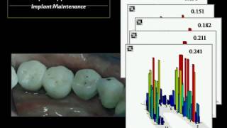 Implant Management with TScan™ Part 2 [upl. by Larual]