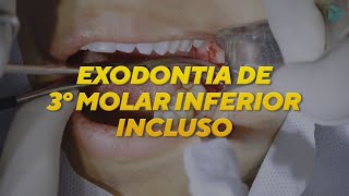 EXODONTIA DE TERCEIRO MOLAR INCLUSO  CIRURGIA [upl. by Aridnere569]