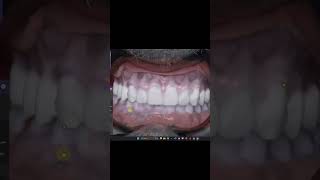 Efficient Digital Denture Design [upl. by Danyluk]