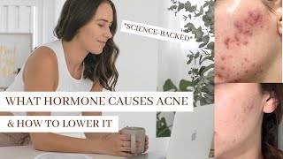 What Hormone Causes Acne PUT AN END TO HORMONAL ACNE [upl. by Onfroi]