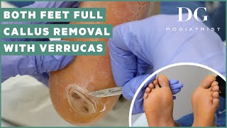 Callus removal from feet both feet and three verruca plantar warts treatment [upl. by Goerke]