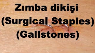 Zımba dikişi Surgical Staples Gallstones 19042015 [upl. by Runkle]