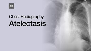 Chest Radiography Atelectasis [upl. by Attenej]