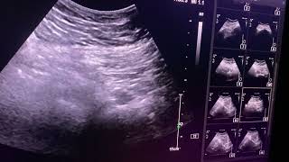 Muscle hematoma posterior hip sacrospinous region usghiphematoma pain [upl. by Asp928]