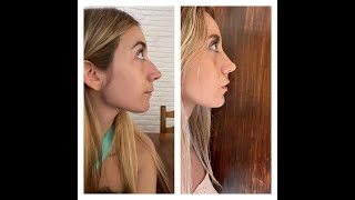 Rinoplastia sin dolor en Mar del Plata Argentina en 16 días Experiencia completa [upl. by Llehcim]