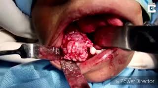 Doctors Remove 526 Teeth From Seven Year Old’s Mouth [upl. by Bronnie]