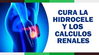 Hidrocele Tratamiento Natural  Hidrocele Testicular  Como Eliminar Calculos Renales [upl. by Rovaert]