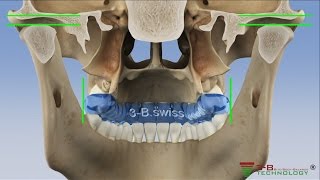 wwwfroehlitherapeuticsch  medizinische Schienentherapie Korrektur Knirscher amp Aufbissschiene [upl. by Ramed]