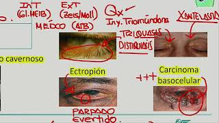 Blefaritis conjuntivitis [upl. by Anowahs538]