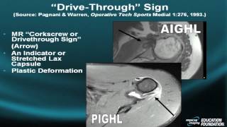 Shoulder MRI Instability Part VI [upl. by Aleel303]