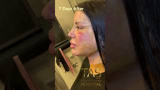 Complete Facial Transformation Scarless Facelift Necklift amp Rhinoplasty by DR Tas [upl. by Stutzman]