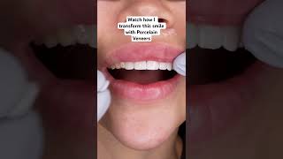 Porcelain veneer smile transformation orthodontist dentaltransformation dentalrestoration [upl. by Ia]