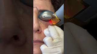 Removing Veins Around the Eyes with Laser  Orbilase Treatment with Dr Parsa [upl. by Eatnuahs651]