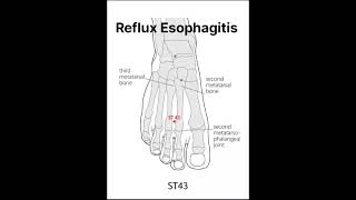 Reflux Esophagitis Acupressure points shorts acidity [upl. by Meeks]