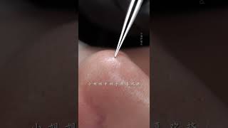 ImmersiveSkinCare Blackheads SkinManagement asmr Facialspa shorts [upl. by Lyda]