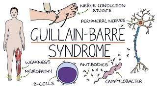 Understanding GuillainBarré Syndrome [upl. by Abdella]