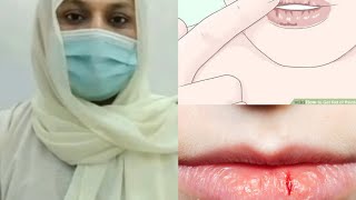 Cracked lipschapped lipsdryness dehydrated lips in URDUHINDI homeopathicmedicine Crackedlips [upl. by Aidyl]