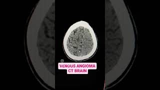 Venous Angioma CT Brain Explained [upl. by Magill]