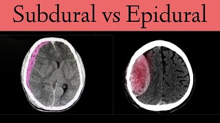 Subdural vs Epidural HematomaHemorrhage CT Scan Findings [upl. by Copp]