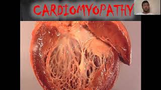 Cardiomyopathy [upl. by Sully]