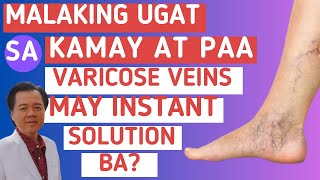 Malaking Ugat sa Paa at Kamay Varicose Veins May Instant Solution Ba [upl. by Ardeha]