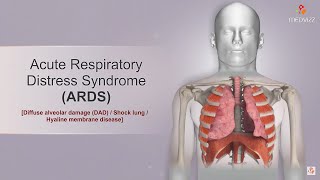 Acute respiratory distress syndrome  ARDS  Etiology Clinical features Diagnosis and Treatment [upl. by Kcyred]