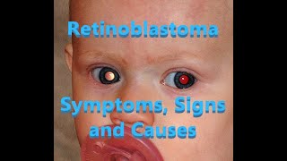 Retinoblastoma  Symptoms Signs and Causes [upl. by Carri486]