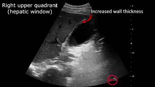 Emergency Point Of Care Ultrasound In Right Upper Quadrant Pain CASE 2 Emphysematous Cholecystitis [upl. by Nigrom]