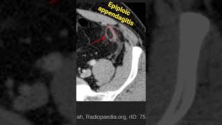 Epiploic appendagitis [upl. by Haran]