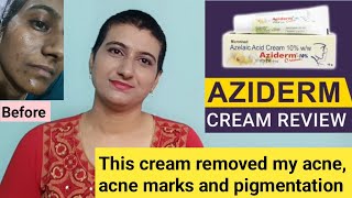 This cream removed my acne acne marks and pigmentation  Aziderm azelaic acid cream review telugu [upl. by Kienan92]