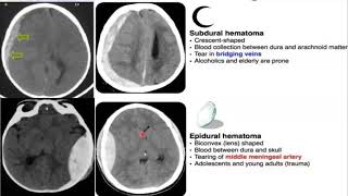 Emergency Neuroradiology Session 1 Spontaneous ICH amp Brain Aneurysms [upl. by Assenar700]