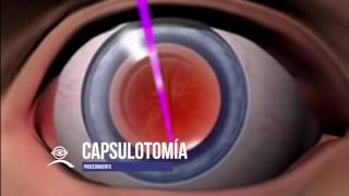 capsulotomía [upl. by Declan]