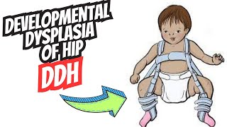 Developmental Dysplasia of the Hip DDH  Diagnosis and Treatment [upl. by Aiuhsoj]