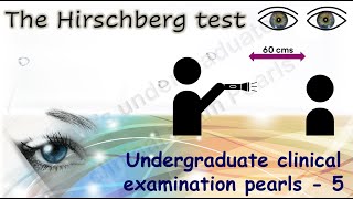 The Hirschberg Test  Undergraduate clinical examination pearls  5 [upl. by Cousins281]