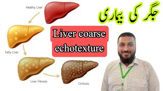 Coarse echotexture liver  chronic liver disease  hepatitis fatty liver [upl. by Ytnom421]