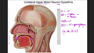 Unilateral Upper Motor Neuron Dysarthria  example and tutorial [upl. by Hanako]