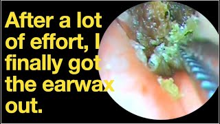 After a lot of effort I finally got the earwax outear wax removal  ear cleaning  ASMR  relax [upl. by Windham]