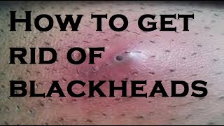 How To Get Rid Blackheads [upl. by Einhpets943]