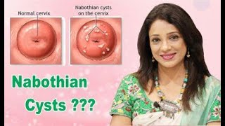 Nabothian cyst क्या होती हैं [upl. by Areid766]