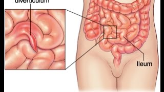 Meckel Diverticulum [upl. by Orlena]