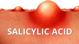 Heres WHY Salicylic Acid is Best For ACNE [upl. by Weathers500]